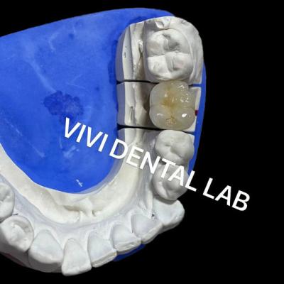 Chine Ivoclar Scheftner couronnes en porcelaine métallique couronnes en céramique métallique Ni être libre à vendre