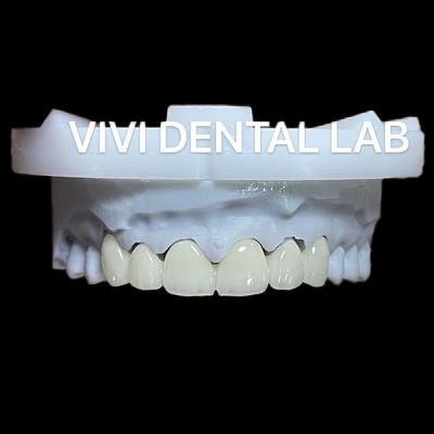 China Dental Anterior Zirconia Bridge ISO Certified Fast Turnaround Time for sale