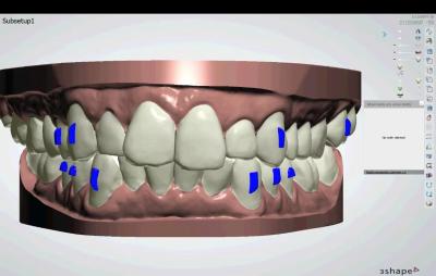 China Professional Teeth Alignment Correction Scheu Clear Correct Aligners for sale