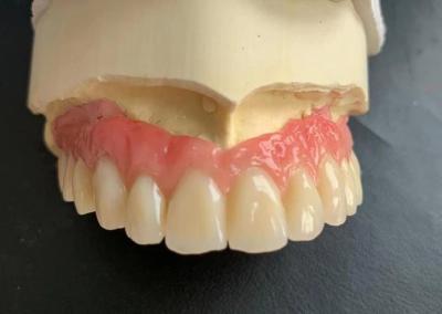 China Telescopic Crown Implant Supported Dentures Ivoclar Scheftner On Titanium Abutments for sale