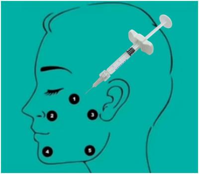 China gel ácido hialurónico ácido hialurónico ligado cruz do enchimento de 32mg H-HA L-HA não à venda