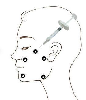 Chine Remplisseur lié non croisé d'acide hyaluronique d'OEM Profhilo H+L 32mg 5 points d'injection à vendre