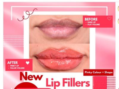 Китай Enhance Your Lips With RED Patented Lip Filler Safe And Effective Lip Augmentation продается