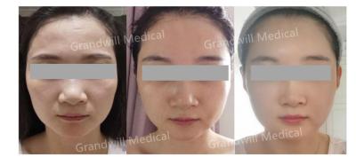 China Hyaluronic Zure PCL-Aanraking van het Huid Hulpmirakel op de Stimulator van het Huidcollageen Te koop