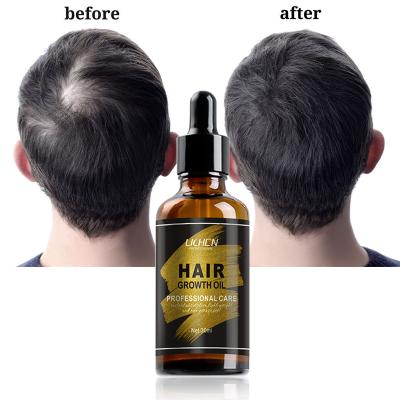 China Loss Prevention Private Label Hair Loss Treatment Oil Organic Hair Loss Oil For Fast Hair Growth Effect for sale