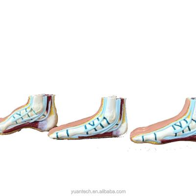 China Durable Human Normal And Abnormal Suit Feet, Anatomy Model 3 Set for sale