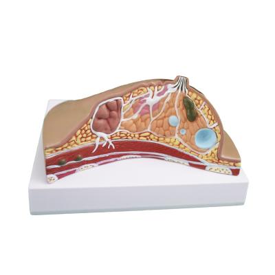 China Detailed Structures Artificial Pathological Female Breast Anatomy Model for sale