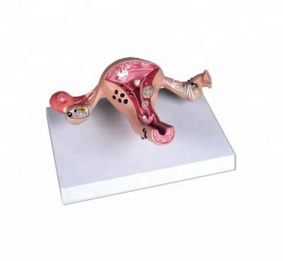 China Durable diseased uterus anatomical medical model for sale