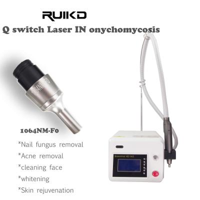 China Laser del Nd Yag en hongos fungosos del clavo del laser del clavo de Onychomycosis con 1064nm-F0 en venta