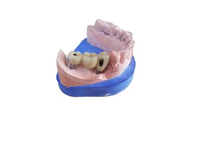 Китай Крона Zirconia CAD CAM зубоврачебная с устоем Zirconia основания титана продается