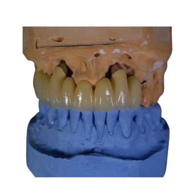 China La porcelana de la corona del FDA PFM se fundió a la corona del metal en venta