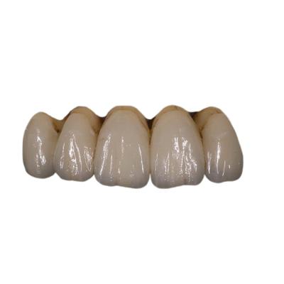 China Fácil mantenha a estabilidade de cor dental da coroa da porcelana ortodôntica de PFM à venda