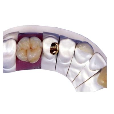 China Coroa dental da porcelana de PFM à venda