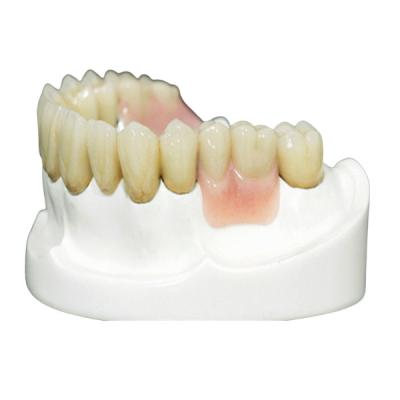 China Proteção fina Overdenture das dentaduras parciais da precisão da alta intensidade MK1 à venda