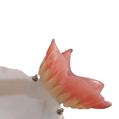 China High Biocompatibility Precision Attachment Denture CAD-CAM Implant for sale