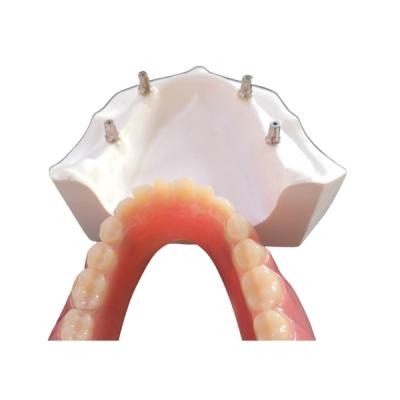 China O implante dental confortável Overdenture do CAD CAM fácil mantém à venda