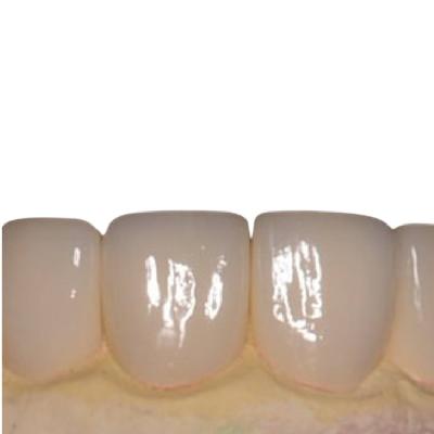 China Smooth Porcelain Teeth Veneers No Irritation Beautiful White Porcelain Veneers for sale