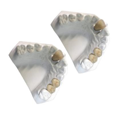 China Lab Yellow Gold Porcelain Dental Crown Co-Cr PFM Porcelain Crown for sale