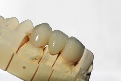 China Limpio de alta calidad del puente dental de la corona de la buena estabilidad y ordenado limpios y ordenados en venta