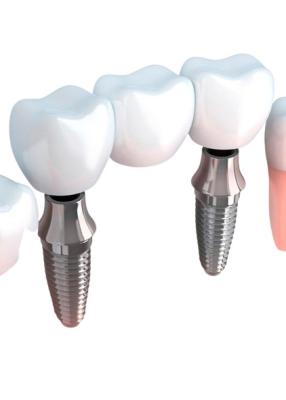 China Color natural dental de la estabilidad fuerte de las coronas y de los puentes del aspecto realista en venta