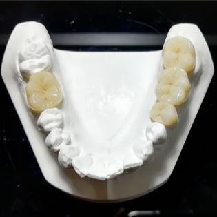 China Unwavering Quality The Mark Of Our Ceramic Dental Crowns for sale