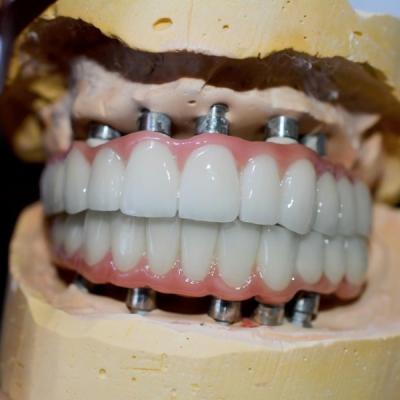 China A viagem a um sorriso saudável nosso processo da coroa do implante dental à venda