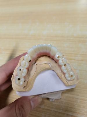 China Elevating Standards Our Dental Implant Crown Quality Assurance for sale