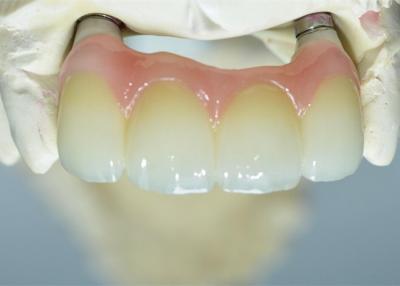 China zirconia bridge restoration zirconia for sale