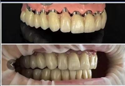 China Dental implants Telescope PFM porcelain bridge à venda