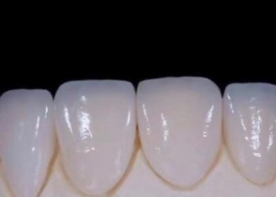 China EMAX    Durablity CAD/CAM Dental Composite Veneers Highly Detailed Accurate for sale