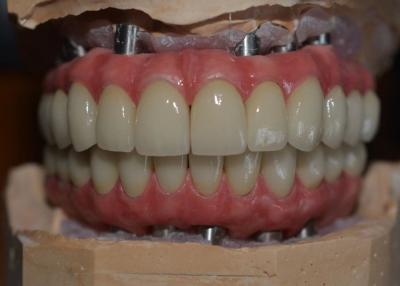 China O poder da precisão que Crafting coroas do implante dental à venda