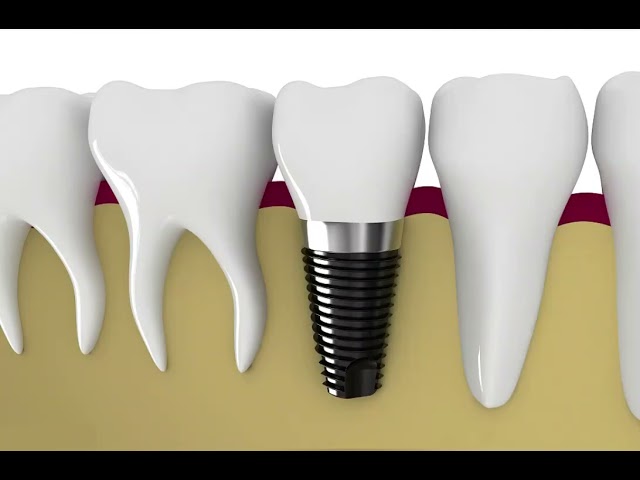 Safe Reliable Artificial Root Implant Long Service Life Natural Dental Implant Bar