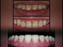 Custom OEM Dental Porcelain Veneer Firm Wear Resistant For Dental Restoration