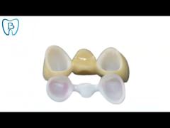 PFM Co Cr 3014652903 Ceramic Dental Bridge Custom Colour Stability