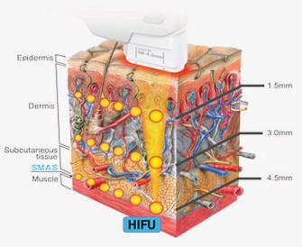 China High Intensity Focused Ultrasound HIFU beauty   machine for Face Lifting and Wrinkle Removal for sale