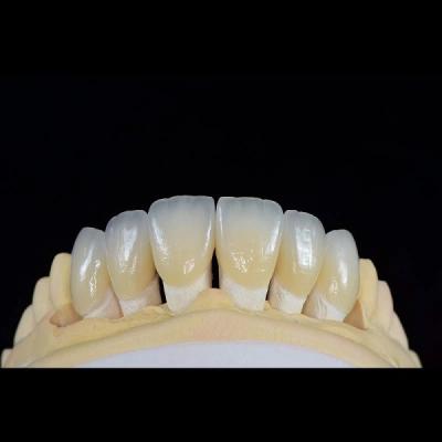 China Feldspathic Porcelain Dental Veneer Layered Zirconia Fabrication for sale