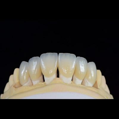 China Dentes de laboratorio de odontología carillas de porcelana feldspáticas a medida en venta