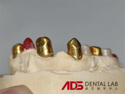 China Dental Telescopic Crowns Prosthesis In Dentistry Customizable for sale