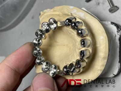 China Coroa de telescopio para prótesis dentales en venta