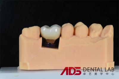 China Dental Missing Teeth Cement Retained Implant Crown Replacement Custom for sale