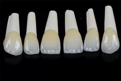 China Las carillas de porcelana dental blancas permanentes duraderas y resistentes a las manchas en venta