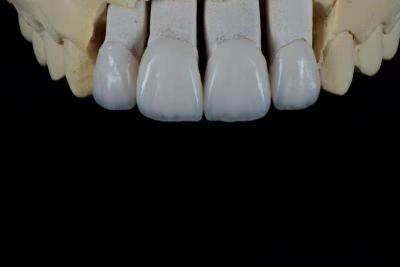 China Handcrafted Porcelain Feldspathic Dental Veneer Natural Looking for sale