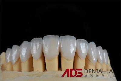 China La limpieza dental de la porcelana laminada feldspática sin costuras personalizada en venta