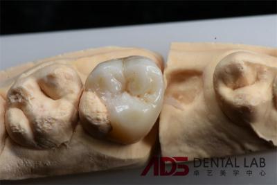 China Servicios de restauración dentaria de incrustación y onlay de cerámica compuesta y biocompatible en venta