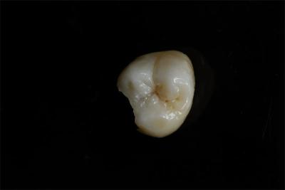 Cina Infissi e infissi in ceramica personalizzabili nella restaurazione dentale in vendita