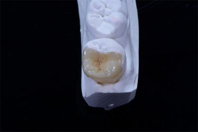 China Coroa Dental Inlays e Onlays Compostos Restauração Forma personalizada à venda