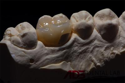 Cina Infissi dentali in ceramica di precisione e onlays di restauro resistenza alle macchie in vendita