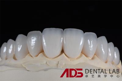 China Dental Porcelain Emax Laminate Veneers Seamlessly Customized for sale