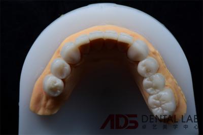 China Alta resistência à mancha Dental Emax Cerâmica Veneers Coroa Para Dentes 400MPa à venda