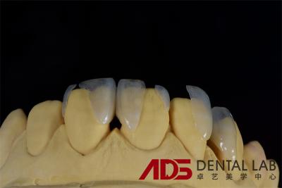 Cina Protesi estetiche Emax Tutte le corone in ceramica denti anteriori OEM in vendita